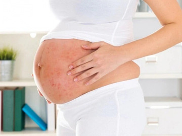 Thai phụ khi mắc bệnh sởi cần lưu ý gì?