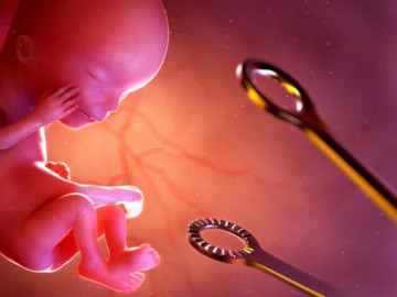 Băng huyết nguy kịch sau khi uống thuốc phá thai mua trên mạng