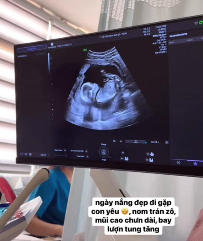 Hoa hậu tiết lộ em bé trong bụng mũi cao, chân dài.
