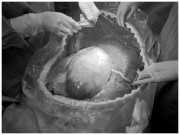 Bà bầu - Cặp song sinh chào đời nguyên vẹn trong bọc ối được ví như "Na Tra" ngoài đời thực