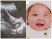 Bà bầu - Vỡ ối sớm khiến thai nhi thò chân ra ngoài, người mẹ quyết tâm giữ con bằng mọi giá