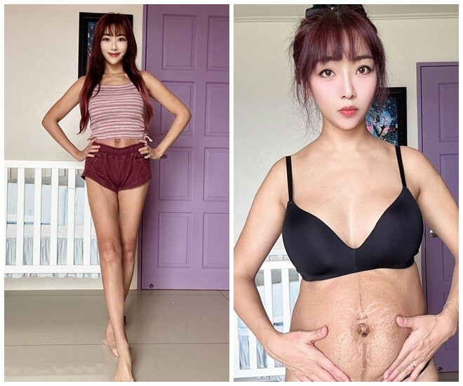 Lý Mật không ngần ngại khoe bụng có nhiều vết rạn.