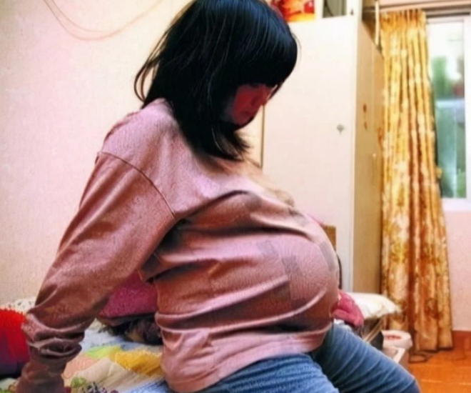 Bụng của chị Vũ Quân Bình ngày càng to bất thường.