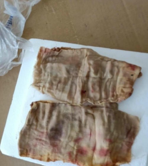 Miếng gạc được lấy từ trong bụng của chị Nhậm.