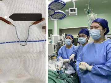 Đặt vòng tránh thai 20 năm, người phụ nữ sốc nặng khi phát hiện chiếc vòng “đi lạc” đến vị trí khó tin