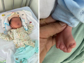 Bố mẹ bàng hoàng khi con chào đời dị tật dù siêu âm 8 lần không phát hiện bất thường