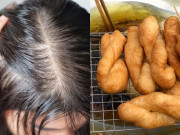 Đẹp - Càng ăn nhiều 2 thứ này tóc càng rụng tơi tả, sau vài năm trông già đi nhanh vì hói đầu