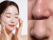 Đẹp - Tại sao nói mụn đầu đen là "khắc tinh" của tài lộc? Bác sĩ da liễu chỉ cách dọn sạch bong từng lỗ chân lông