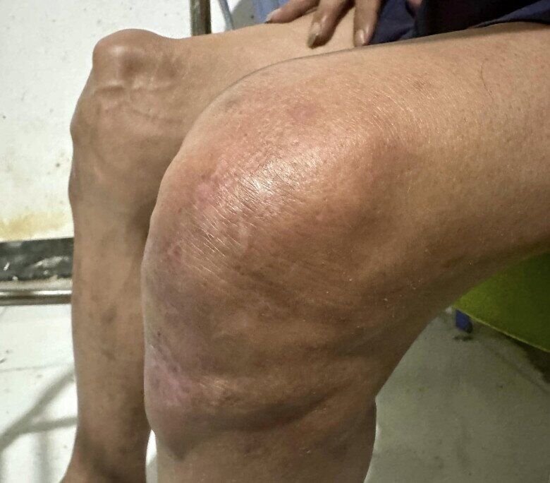 Đôi chân của Thương Tín biến dạng sau khi bị tai nạn.