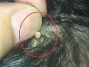 Con kêu đau, mẹ bàng hoàng khi phát hiện hạt kê dính chặt ở da đầu, BS nói Đó là thứ đáng sợ
