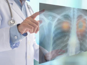 Sức khỏe - Người đàn ông bị ung thư phổi di căn lên não, sau 4 tháng kiên trì làm một việc điều kỳ diệu đã đến