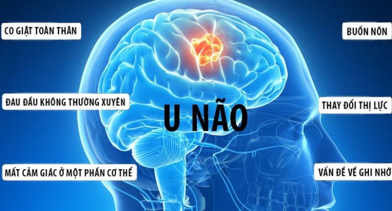 Một số biểu hiện của khối u não cần phải rất cảnh giác và đi đến bác sĩ. Tác phẩm nghệ thuật. 