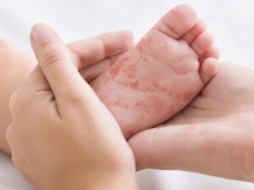 Bệnh nhi 2 tuổi tử vong nghi do mắc sởi sau chưa đầy 24 giờ nhập viện