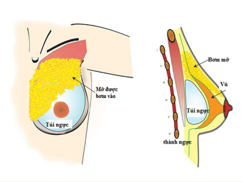 Hybrid Breast Augmentation – Kết hợp túi độn và mỡ tự thân để đạt được vẻ đẹp mềm mại, tự nhiên