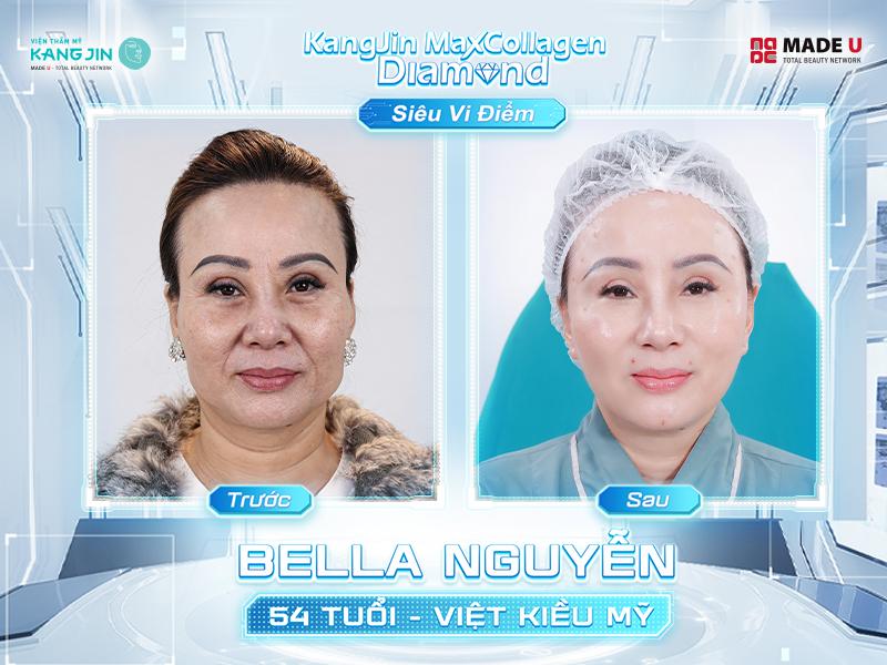 Chị Bella Nguyễn (Việt kiều Mỹ) chia sẻ: “Từng là người gặp thất bại trong phẫu thuật thẩm mỹ, tôi luôn e ngại và dè chừng với các phương pháp làm đẹp truyền thống. Tuy nhiên, sau khi được bác sĩ Tiến tư vấn liệu trình trẻ hóa bằng công nghệ cao, tôi đã hoàn toàn yên tâm. Sau khi điều trị tại Viện thẩm mỹ KangJin, làn da của tôi trở nên căng mịn, các nếp nhăn ở khóe miệng và vùng mắt mờ đi rõ rệt mà không cần phải trải qua quá trình phẫu thuật đau đớn hay thời gian hồi phục kéo dài.”