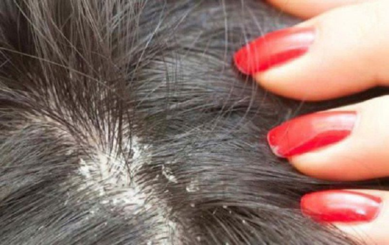 Nấm da đầu là tình trạng khá phổ biến nhiều người gặp phải