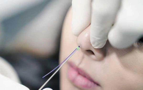 Công nghệ nâng mũi bằng chỉ là một phương pháp thẩm mỹ không xâm lấn, ít gây tổn thương hơn so với phương pháp nâng mũi truyền thống.