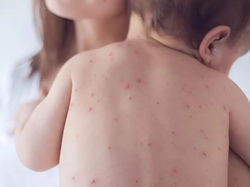 Nhiều trẻ ở TP.HCM nhập viện do sởi, tình hình bệnh chưa có dấu hiệu giảm sau Tết Nguyên đán, kéo dài so với mọi năm