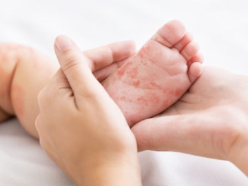 Một bé gái 4 tuổi ở Hà Nội tử vong do sởi