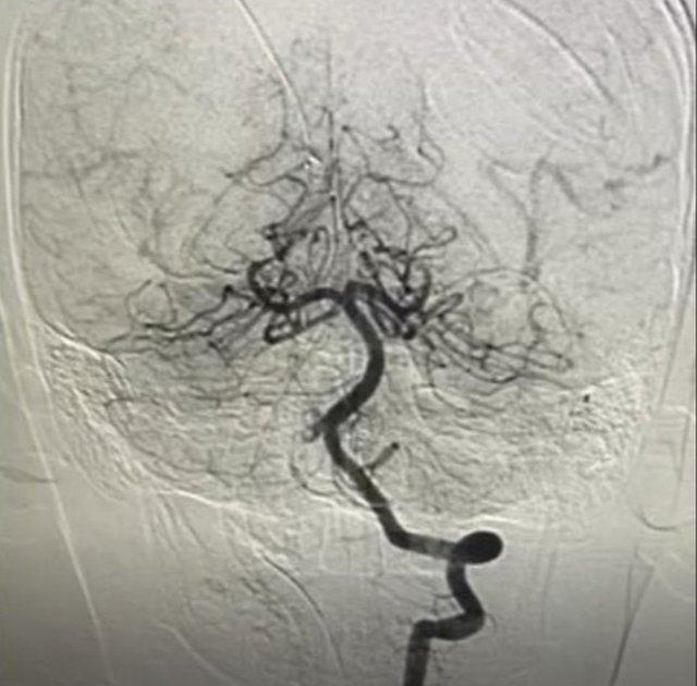 Hình ảnh chụp mạch máu xóa nền DSA. Ảnh: BVCC