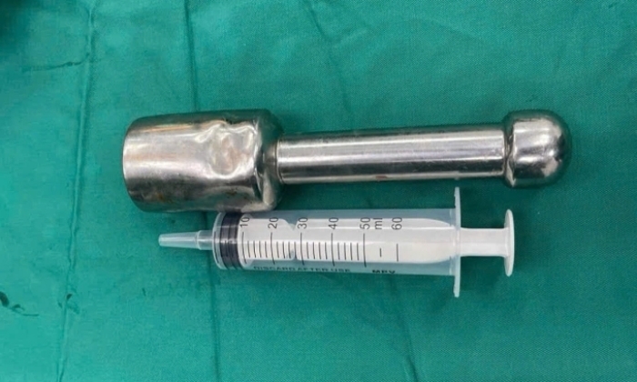 Dị vật sau khi được lấy ra. (Ảnh: BVCC)