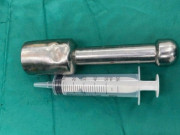 Sức khỏe - Chiếc chày 18 cm mắc kẹt trong trực tràng nam sinh 15 tuổi