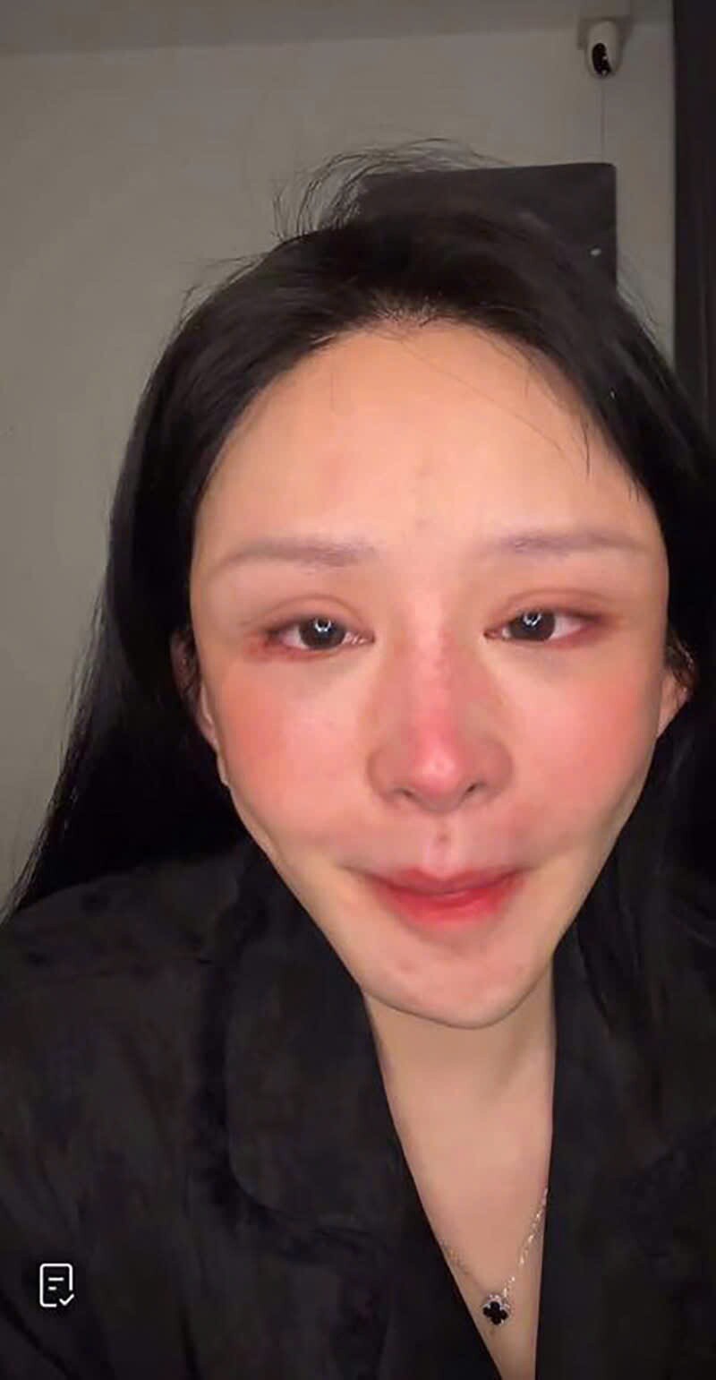 Mạng xã hội amp;#34;dậy sóngamp;#34; với cô gái livestream khóc lóc giữa đêm vì gương mặt biến dạng sau khi thẩm mỹ - 1