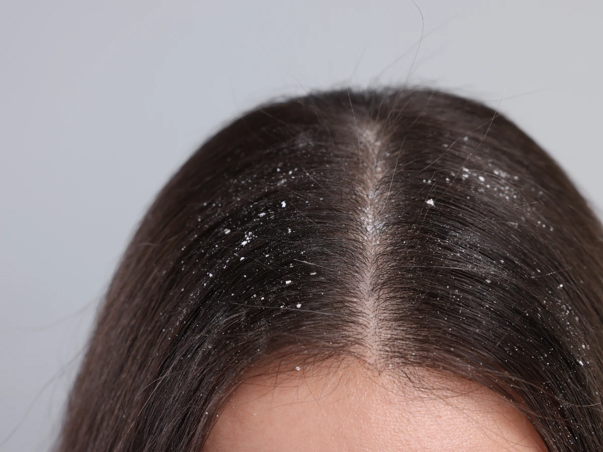 Bác sĩ tiết lộ 6 việc cần tránh khi gội đầu kẻo tóc amp;#34;rụng như mưaamp;#34;, có một hành động hại nang tóc nhất - 3