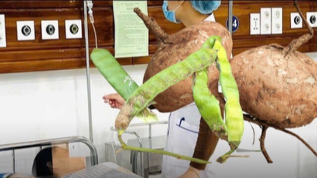 Tình trạng sức khỏe 6 người trong gia đình nhập viện vì ngộ độc hạt củ đậu