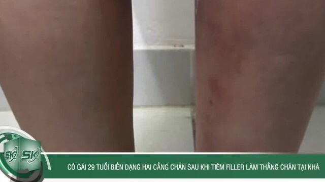 Cô gái 29 tuổi biến dạng hai cẳng chân sau khi tiêm filler làm thẳng chân tại nhà
