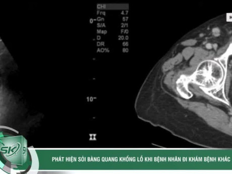 Phát hiện sỏi bàng quang khổng lồ khi bệnh nhân đi khám bệnh khác