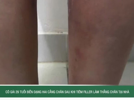 Cô gái 29 tuổi biến dạng hai cẳng chân sau khi tiêm filler làm thẳng chân tại nhà