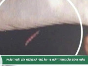 Clip Eva - Phẫu thuật lấy xương cá 'trú ẩn' 10 ngày trong cằm bệnh nhân