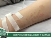 Clip Eva - Người phụ nữ nhiễm cùng lúc 5 loại ký sinh trùng