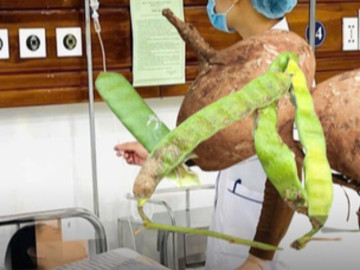 Tình trạng sức khỏe 6 người trong gia đình nhập viện vì ngộ độc hạt củ đậu