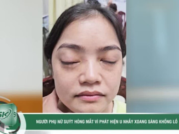 Ngỡ lồi mắt do cường giáp, người phụ nữ suýt hỏng mắt vì phát hiện u nhầy xoang sàng khổng lồ