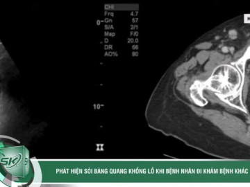 Phát hiện sỏi bàng quang khổng lồ khi bệnh nhân đi khám bệnh khác