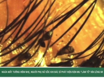 Ngứa mắt tưởng viêm nhẹ, người phụ nữ sốc khi bác sĩ phát hiện rận mu “làm tổ” kín lông mi