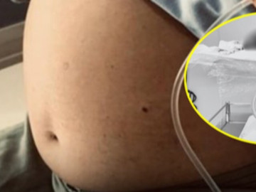 Bóc tách thành công khối u xơ tử cung “khổng lồ” cho nữ bệnh nhân 25 tuổi