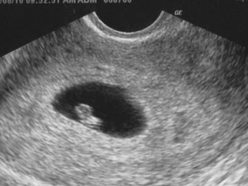 Bà bầu - Đẻ xong thấy cơ thể có dấu hiệu lạ, cô gái 19 tuổi khiến ê-kíp bác sĩ sững người khi xem kết quả siêu âm