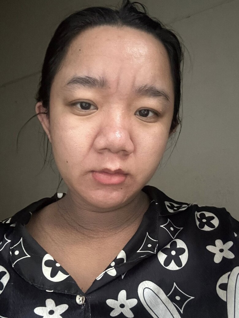 Đến tuần thứ 33, bà bầu stress vì mũi nở, gương mặt xuất hiện nhiều nếp nhăn.