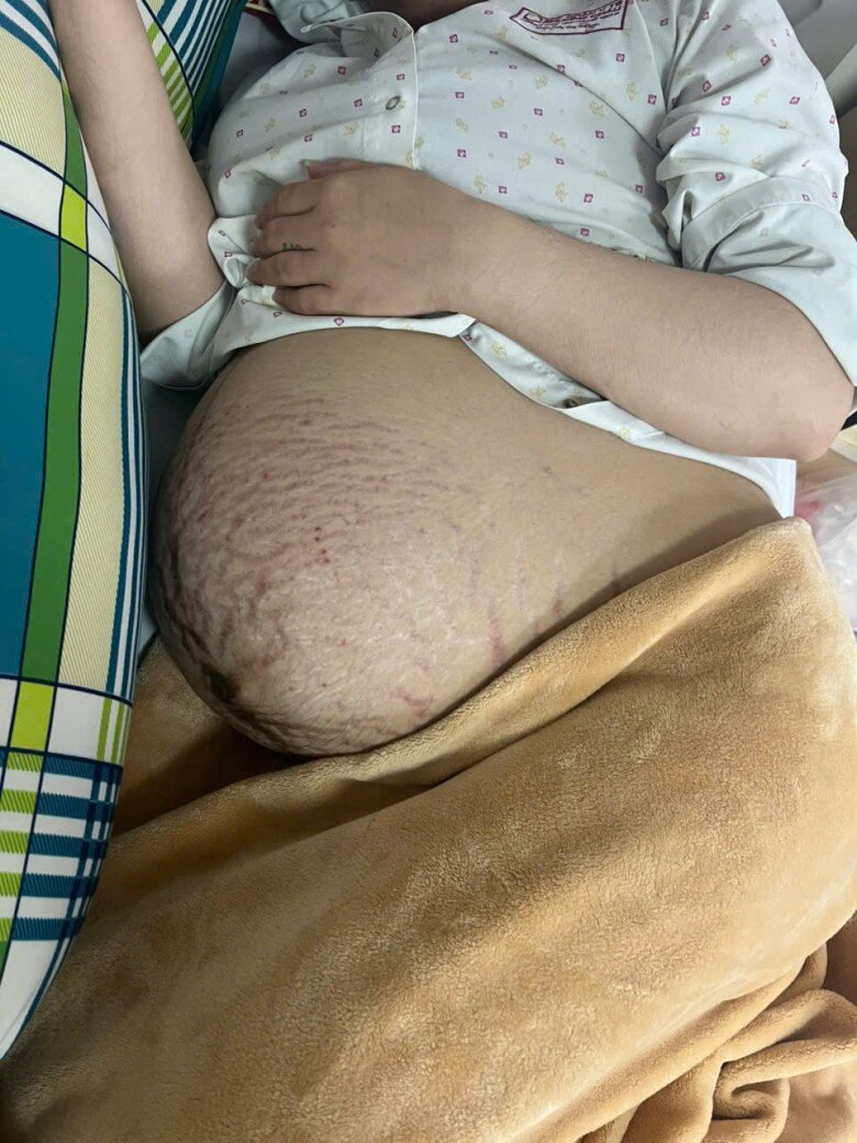 Mẹ bầu khâu cổ tử cung, đặt vòng nâng tử cung để giữ thai, bụng rạn chi chít vết rạn tím.