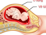 Bà bầu - Sản phụ 29 tuổi vỡ tử cung trong đêm thừa nhận 1 sai lầm nhiều phụ nữ Việt mắc phải