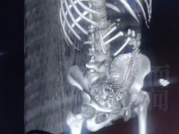 Bà bầu - Con gái đi học về xuất hiện bất thường ở vùng kín, mẹ vội đưa vào viện khám, kết quả chụp CT khiến bác sĩ tái mặt