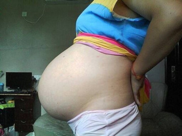 Bà bầu - Cô gái trẻ bụng phình to như cái trống dù không hề mang bầu, kết quả chụp CT khiến ê-kíp bác sĩ tái mặt