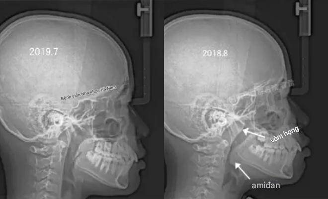 Đứa trẻ lúc nhỏ xinh, càng lớn càng kém sắc vì thói quen này khi ngủ mà nhiều trẻ em hay mắc phải - 3