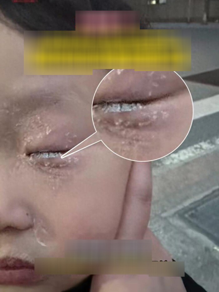 Con bị keo 502 bắn vào mắt, bố nhẹ nhàng đổ thêm một thứ, bác sĩ khen: Hiếm có người thông minh như anh! - 2