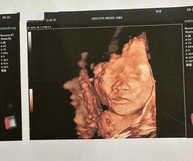 Siêu âm thấy con nhoẻn miệng cười, bố khen đáng yêu, bác sĩ: amp;#34;Em bé không ổn, mẹ chuẩn bị tinh thầnamp;#34; - 3