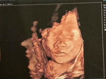 Bà bầu - Siêu âm thấy con nhoẻn miệng cười, bố khen đáng yêu quá, bác sĩ: "Em bé không ổn, mẹ chuẩn bị tinh thần"