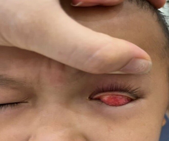 Hình ảnh mắt bé trai bị viêm kết mạc dị ứng nặng phải đến viện điều trị. Ảnh: BSCC.